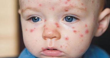 Enterovirusinė infekcija vaikui: gydymas, simptomai, prevencija