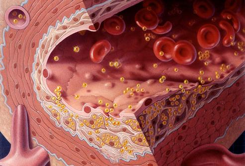 LDL - blogas cholesterolis