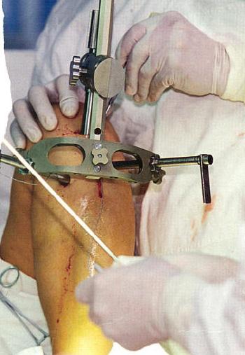 kojų ilgėjimas be chirurgijos