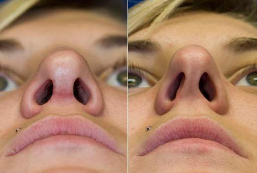 Operacija ištaisyti nosies pertvarą: metodai ir apžvalgos