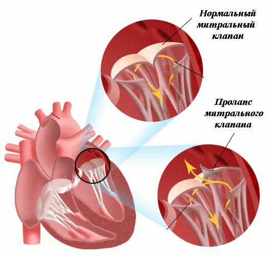 mitralinio vožtuvo prolapso simptomai